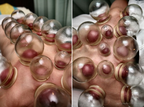 shimworld-cupping-therapy-photography